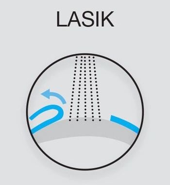 Lasik Eye Surgery near me