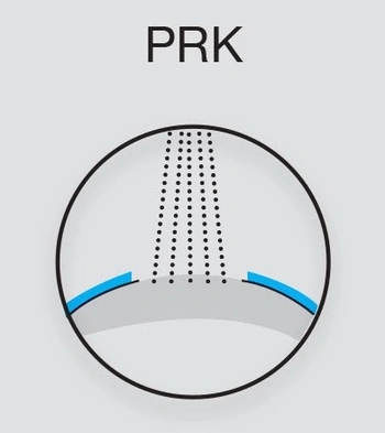PRK (Photorefractive Keratectomy)