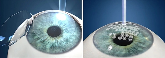 Ortho-K vs LASIK comparison in Cambridge, ON