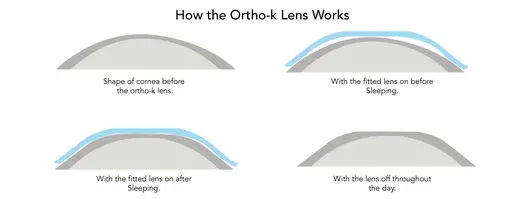 Ortho-K treatment in Cambridge, ON