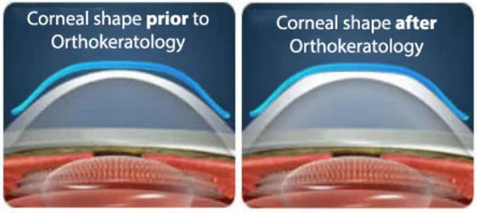 Ortho-K vs LASIK comparison in Cambridge, ON